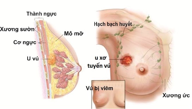 Rối loạn tuyến vú - Hình ảnh minh họa